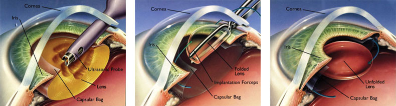 Traditional Cataract Surgery Raleigh | Cataracts Cary