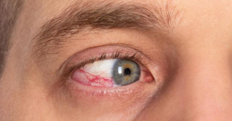 Corneal Ulcer Healing Stages: What to Expect in Recovery