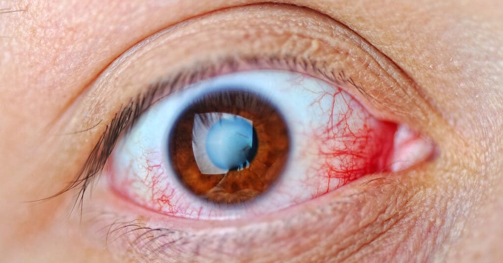 mild corneal ulcer healing stages